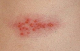 Shingles Pain Like No Other  Community Voices for Health